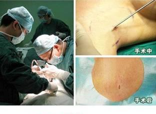 腋臭 手术过程.jpg