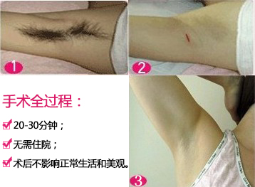 改良小切口汗腺清除术改良小切口汗腺清除术 手术 过程.jpg